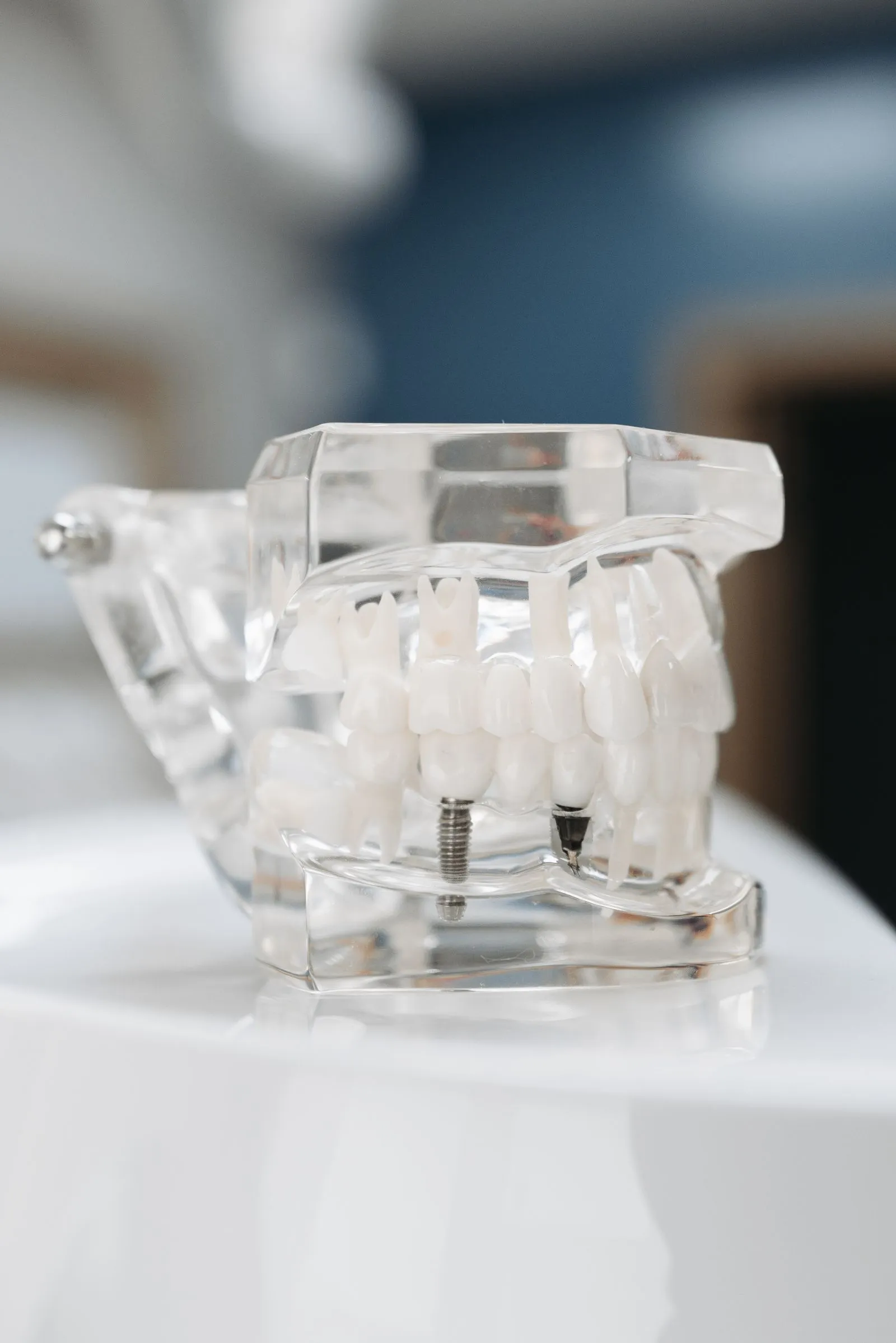 Modelo dental transparente que muestra un implante de titanio, en Florida Centro Dental