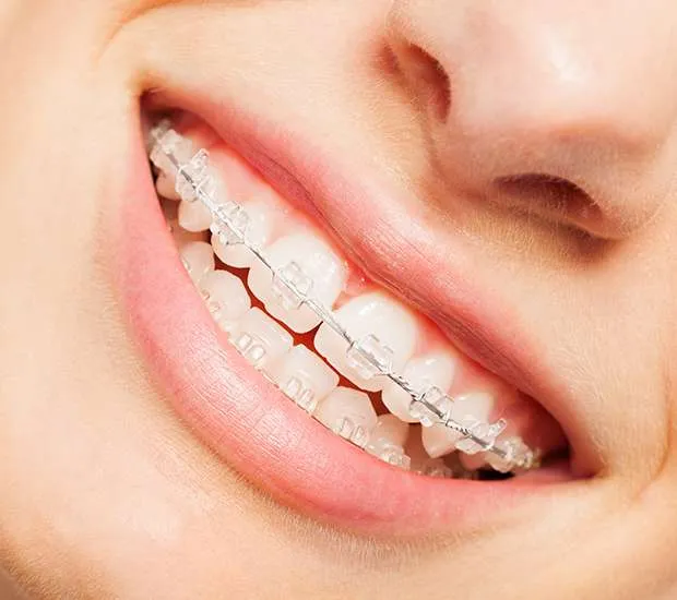 Sonrisa con brackets cerámicos transparentes, tratamiento de ortodoncia en Florida Centro Dental