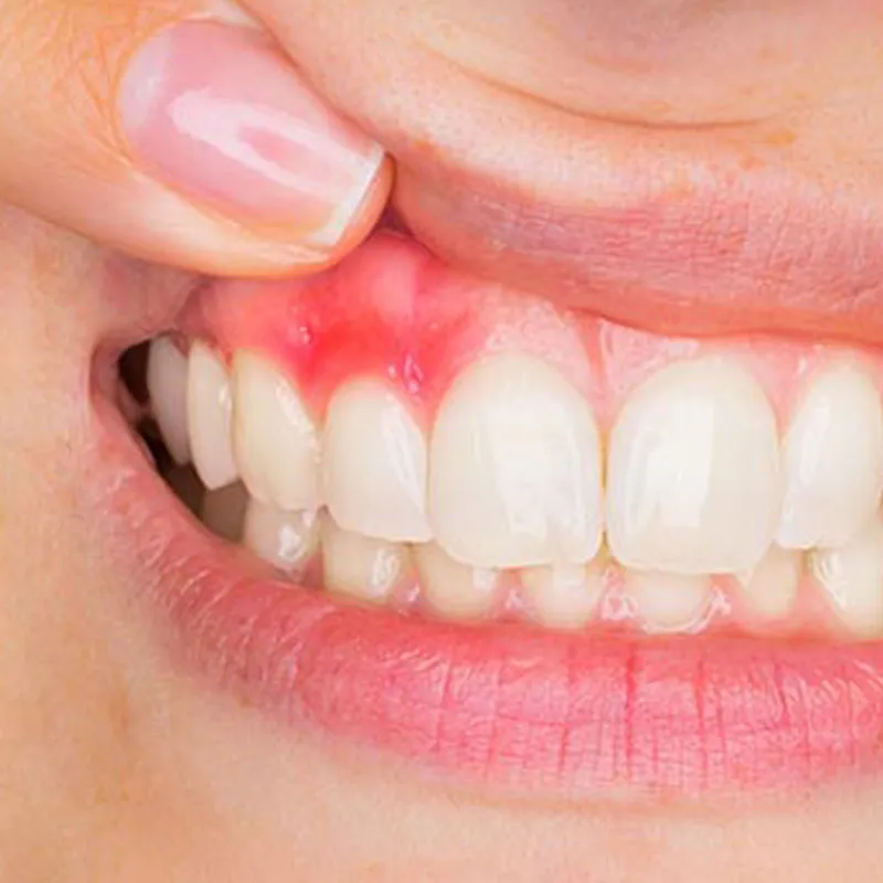 Encía con signos de inflamación, tratamiento de periodoncia en Florida Centro Dental
